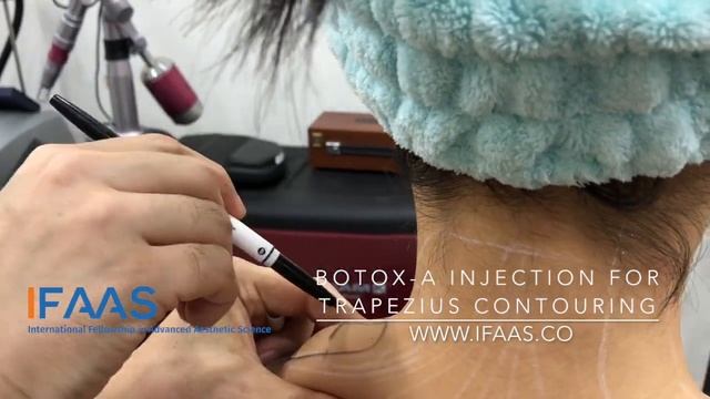 IFAAS Exclusive Technique - Botox-A Injection for Trapezius Contouring смотреть онлайн