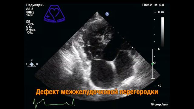 Дефект МЖП + Стеноз Клапана Легочной Артерии смотреть онлайн
