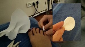 перелом мизинца, пальцев на стопе