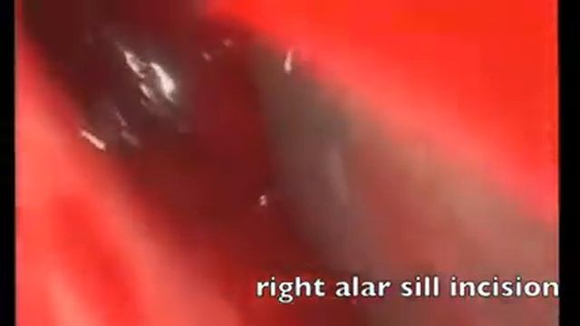 Empty Nose Syndrome: Lateral Wall Implant (English) смотреть онлайн
