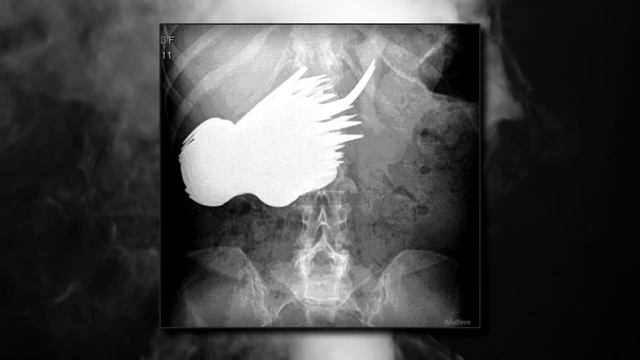 НЕОЖИДАННЫЕ НАХОДКИ В ТЕЛАХ ЛЮДЕЙ смотреть онлайн