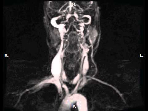 Контрастная МР ангиграфия сосудов шеи динамика пассажа контраста смотреть онлайн