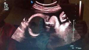 УЗИ пол ребёнка , мальчик