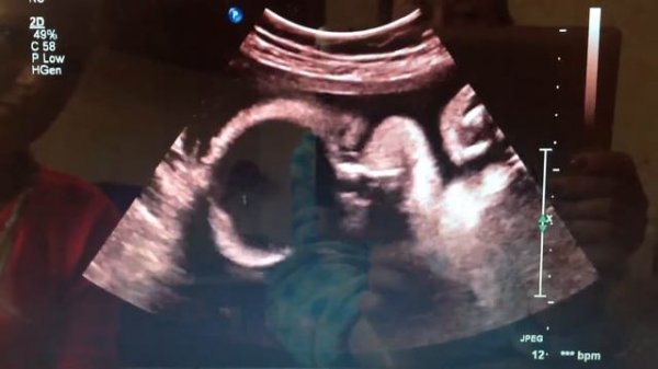 УЗИ пол ребёнка , мальчик