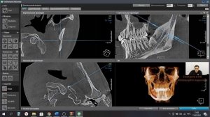 Трассировка нерва в OnDemand. Два способа.