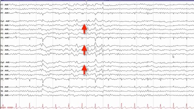 7  EEG In Normal Sleep