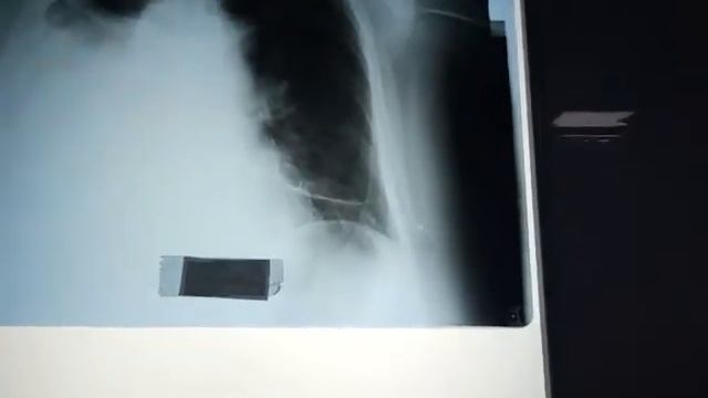 Правосторонний выпот после АКШ смотреть онлайн