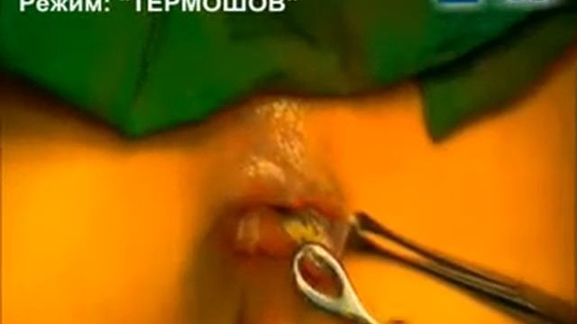 Геморроидэктомия с использованием технологии 