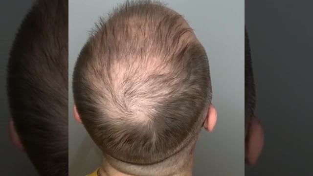 Как скрыть поредение волос? С помощью трихопигментации - татуировки волос! До и заживший результат! смотреть онлайн
