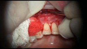 Вестибулопластика