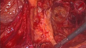 еTEP при левосторонней паховой грыже.