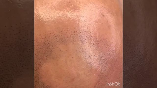 Трихопигментация по методу СМП