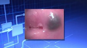 Рак шейки матки