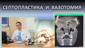 Септопластика и вазотомия с использованием коагуляционного оборудования. ЛОР хирург к.м.н. Фуки Е.М.
