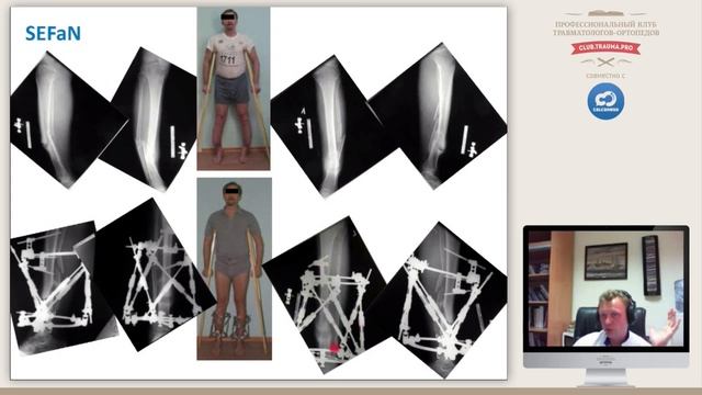 Комбинированное и последовательное применения внешней и внутренней фиксации.