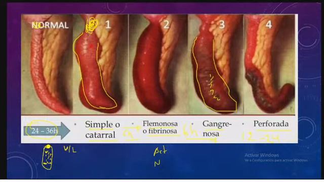 APENDICITIS смотреть онлайн