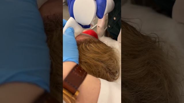 Плановый осмотр на 10-е сутки после пересадки волос. смотреть онлайн
