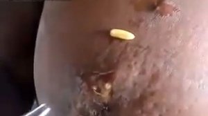 Паразиты. Личинки овода извлекли из груди женщины. Botfly Larvae Removed from Woman's Breast