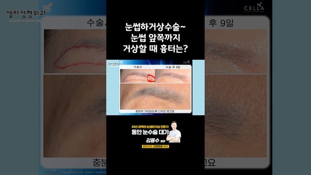 눈썹하거상수술~ 눈썹 앞쪽까지 거상할 때 흉터는? смотреть онлайн