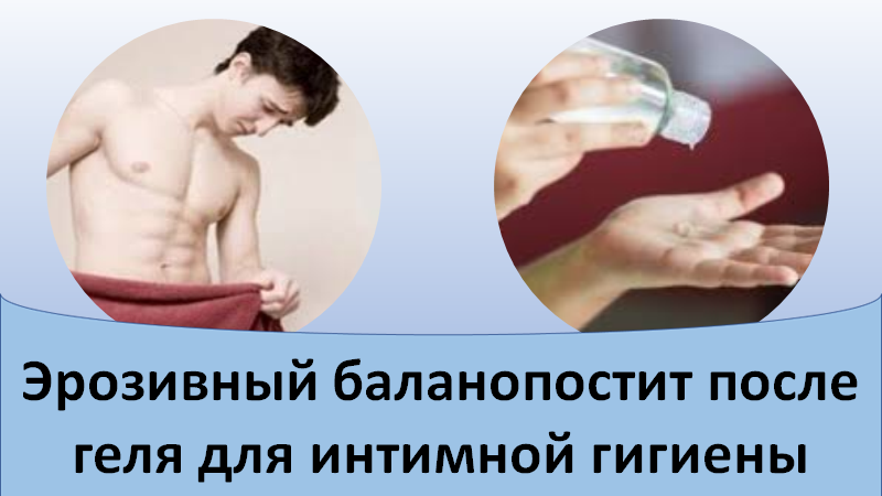 Эрозивный баланопостит после геля для интимной гигиены смотреть онлайн