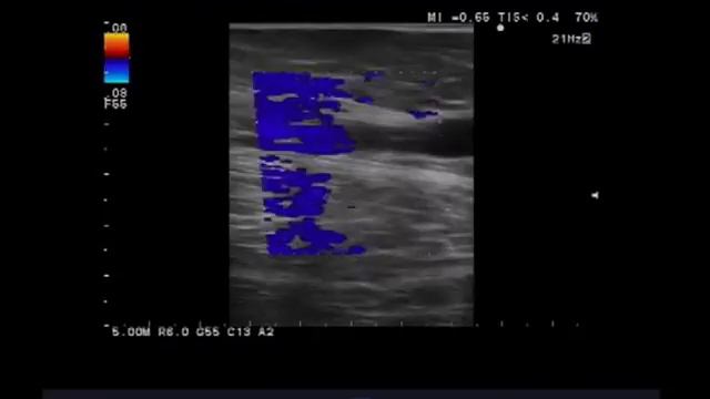 Имитация состоятельного устья БПВ - клип2 смотреть онлайн