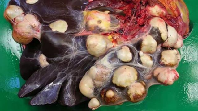 Hydatid Cyst, Liver Cyst Due To Echinococcus Infection