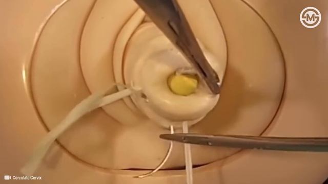 Cervical Cerclage Using With 5 Mm Mersilene Tape: McDonald (4 Steps) Method