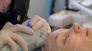 HIFU SMAS лифтинг лица, полная процедура