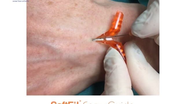 SoftFil® смотреть онлайн