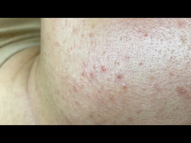 Давим угри скрытые в области шеи, для вас в спа-салоне красоты.