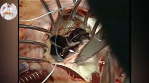 Протезирование митрального клапана механическим протезом