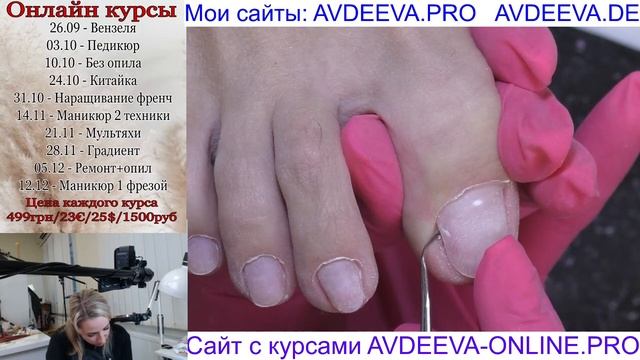 Подногтевые мозоли. Скрученная ногтевая пластина. Педикюр. Виктория Авдеева смотреть онлайн