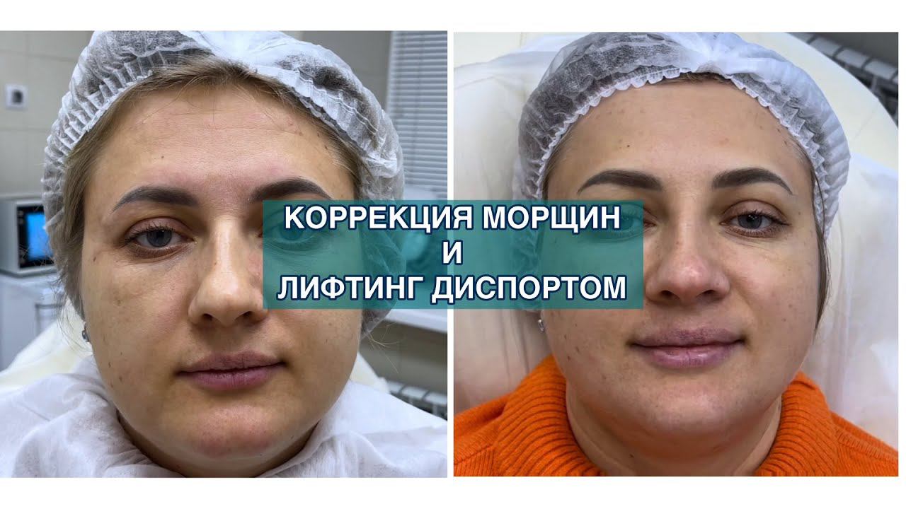 Диспорт FULL FACE для деформационно-отечного морфотипа старения смотреть онлайн