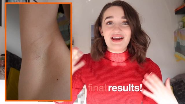 THE RESULTS | LASER HAIR REMOVAL AT HOME | IPL REVIEW: Braun Silk Expert Pro 5 смотреть онлайн