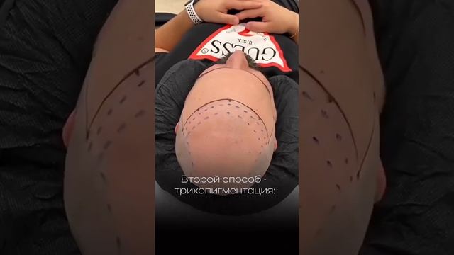 Мужская система волос, трихопигментация или пересадка волос? Запись на конс.в описании канала ? смотреть онлайн