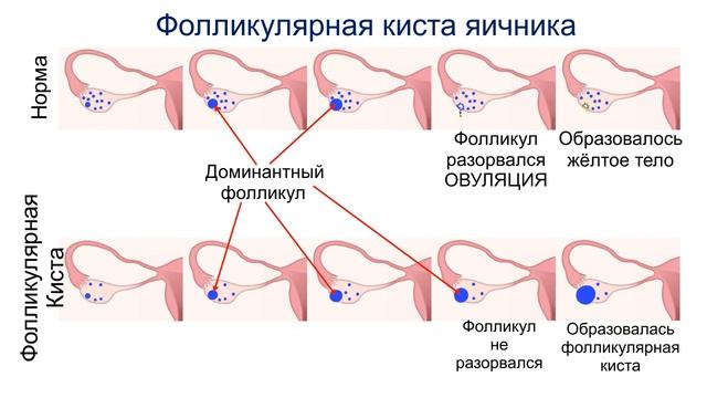 Секс Во Время Кисты Секс Во Время Кисты
