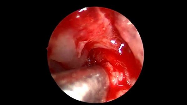 МИЦЕТОМА ГАЙМОРОВОЙ ПАЗУХИ