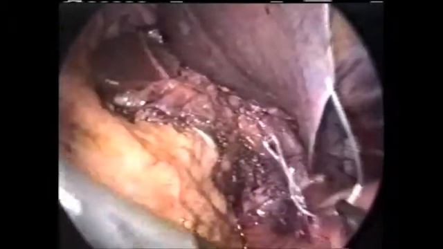 CIMA - Gastrectomia BI (Parte 2) смотреть онлайн