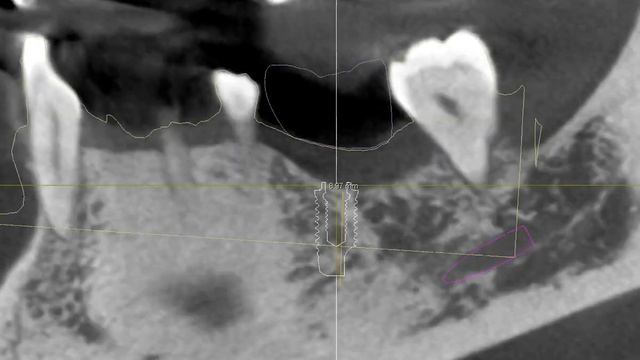 Patient 1 implant 36 смотреть онлайн
