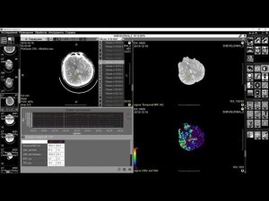 Обучающее видео "КТ-Перфузия головного мозга". Фильм первый