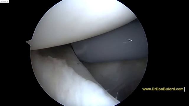L Shoulder Biceps Tenodesis for SLAP 2017 11 02 MG смотреть онлайн