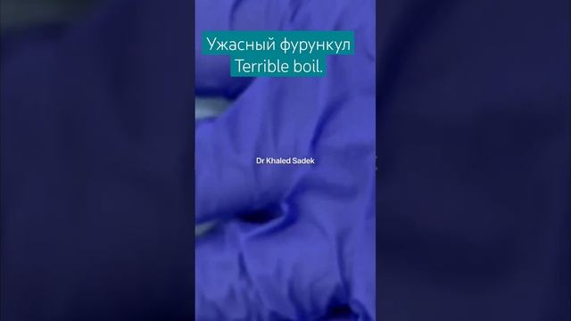 Фурункул / киста/ акне/ Terrible boil / skin care #Shorts смотреть онлайн