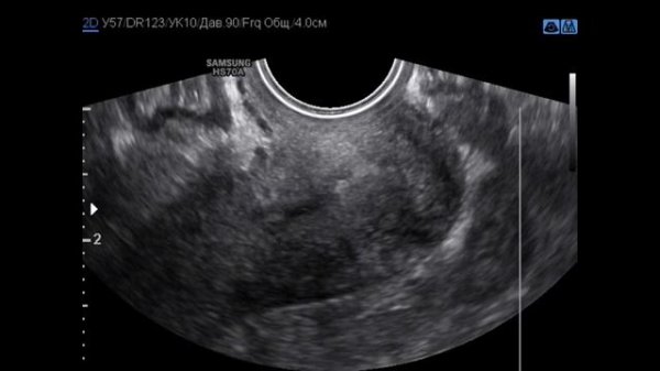 Полип цервикального канала, имитирующий опухоль. Barto-clinic.ru