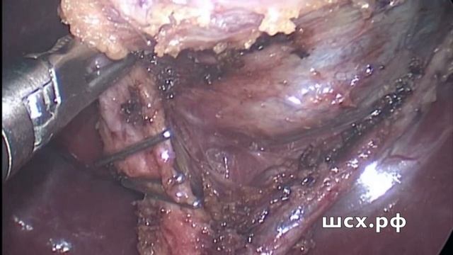 SILS+ холецистэктомия-редкий вариант анатомии артерии