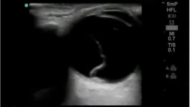 Порядок выполнения: офтальмологическое ультразвуковое исследование на конкретном примере (часть 2) смотреть онлайн