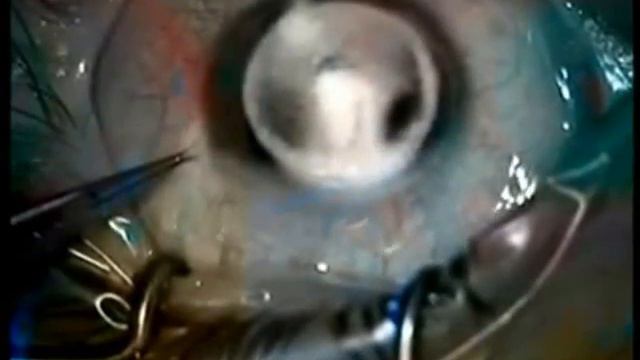 Sarnicola Big Bubble Technique - ASICO LLC смотреть онлайн