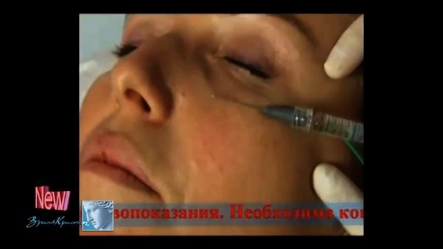 Радиочастотное армирование смотреть онлайн