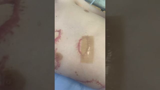 Використання силіконового пластирю "Стопрубець" смотреть онлайн