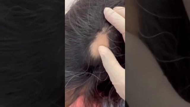 Alopesiya / Saç tökülməsi / Androgen alopesiya смотреть онлайн