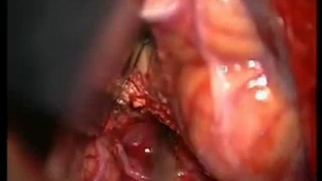 Удаление опухоли IV желудочка.3gp смотреть онлайн